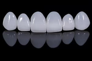 The Difference between Dental Bonding and Veneers |