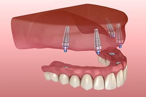 Maxillary prosthesis