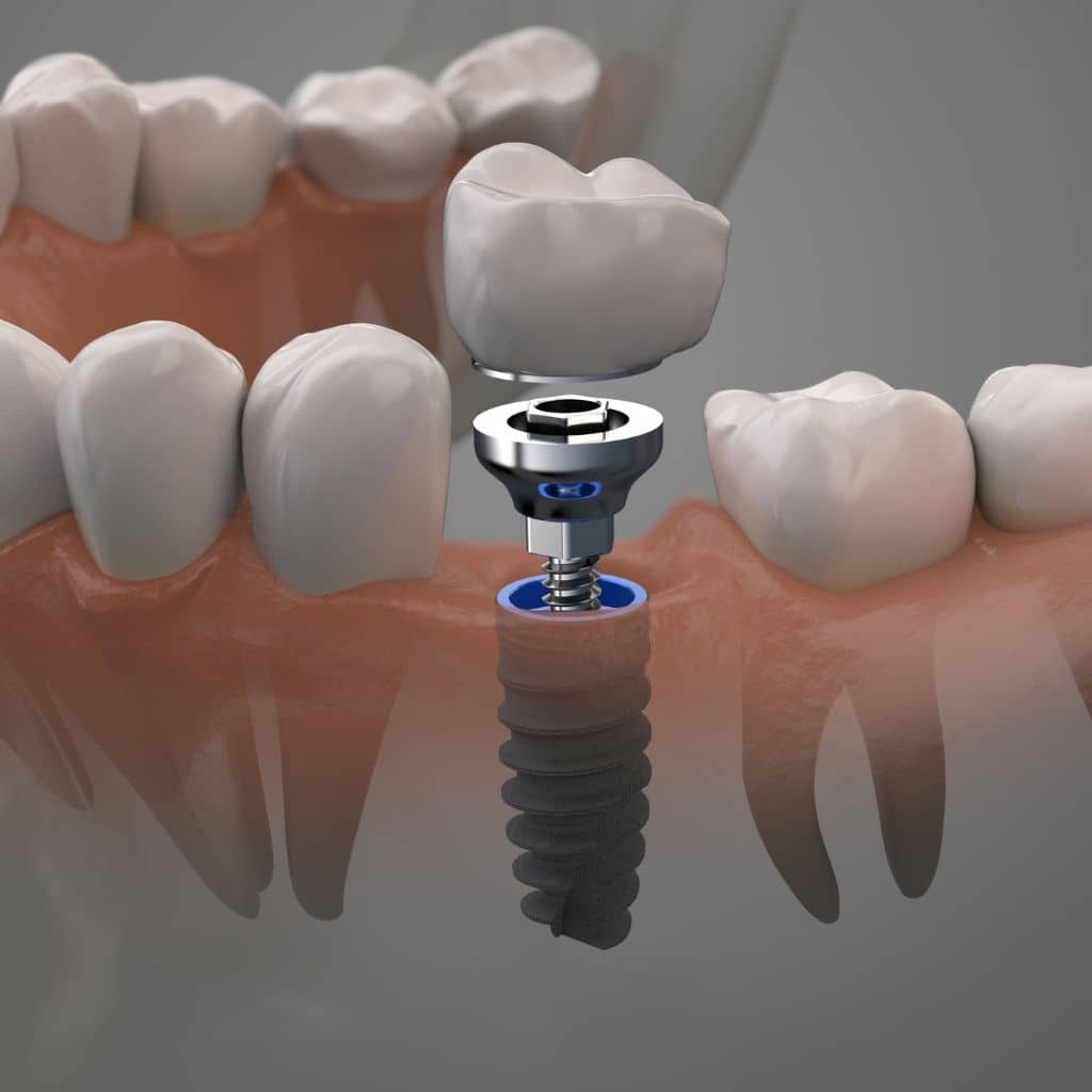 dental implants