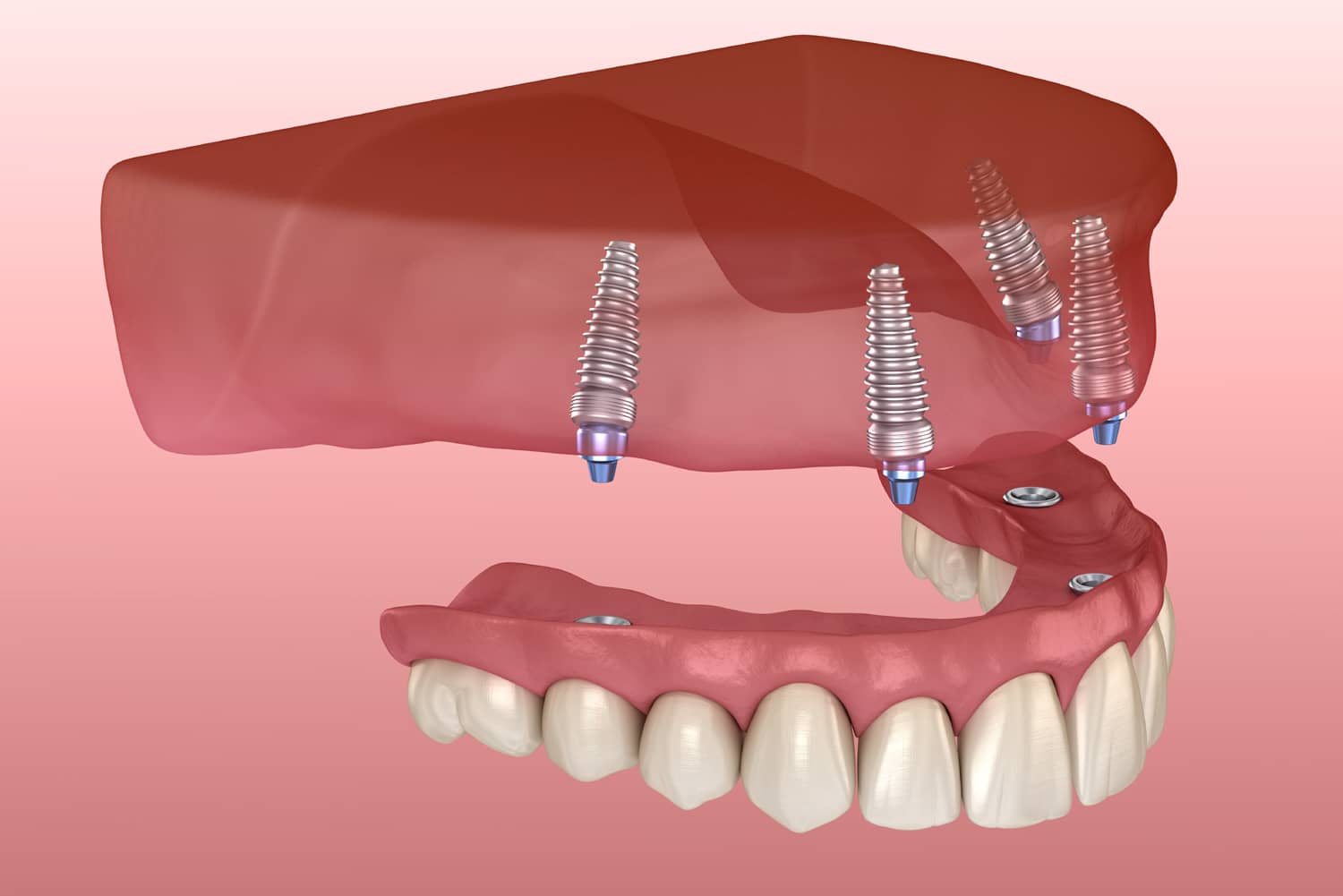 Maxillary prosthesis